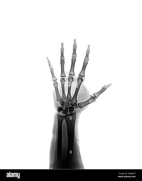 X-ray hand AP view normal Stock Photo - Alamy