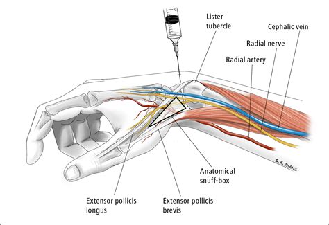 Figure 031_8617. Wrist arthrocentesis. Illustration courtesy of Dr Shannon Zhang. - McMaster ...