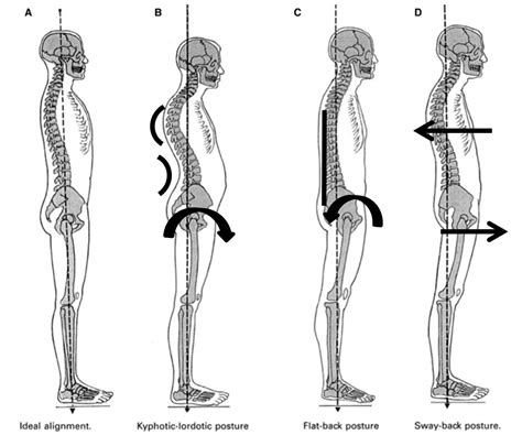 Classic Postural Deviations — Best Physical Therapy NYC