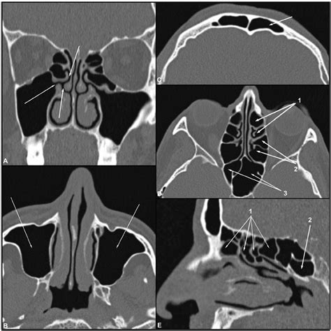 (A–E) Coronal, axial and sagittal CT images of the bone window ...