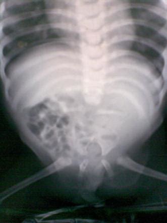 Sacral agenesis | Radiology Reference Article | Radiopaedia.org