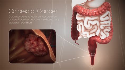 Colorectal cancer: Symptoms, Causes, and Treatment - Scientific Animations