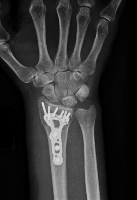 Distal Radius Fracture - Raleigh Hand Surgery — Joseph J. Schreiber, MD