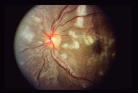 Paracentral Scotoma - Retina Image Bank