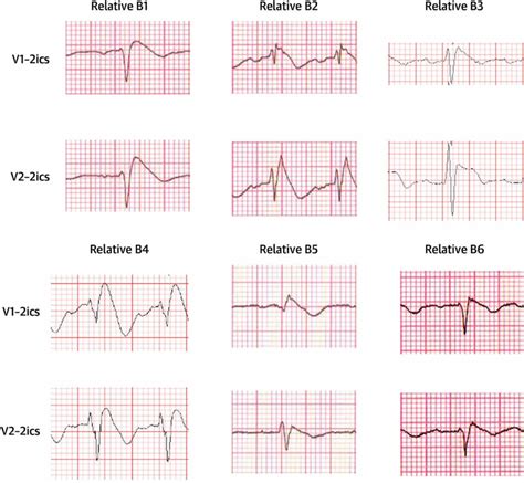 Brugada Syndrome - Causes, ECG, Symptoms, Treatment