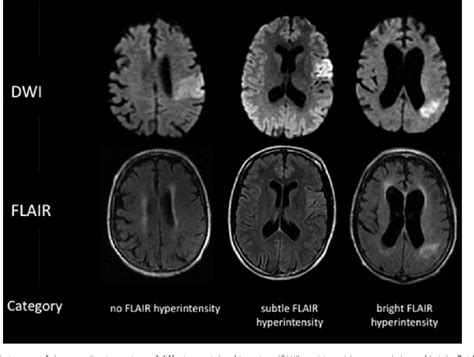 Ischemic Stroke Mri