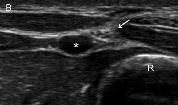 Ultrasound-guided Nerve Blocks in the Emergency… | Relias Media