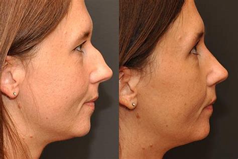 Rhinoplasty | Cincinnati, OH