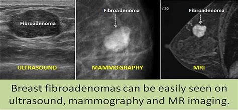 NONSURGICAL TREATMENT OF BREAST FIBROADENOMAS