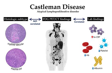 Castleman Disease Symptoms: How 3 Subtypes Are Diagnosed & Best Treatment - Be Your Best, Well, Self