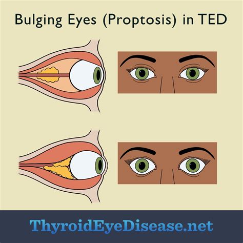 Bulging Eyes (Proptosis): A Symptom of Thyroid Eye Disease