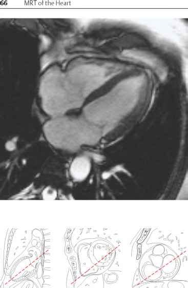 Coronary Artery Anatomy - Sectional Anatomy