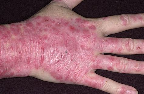 Psoriasis Picture (Hardin MD Super Site Sample)