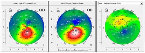 A New Era of Keratoconus Care