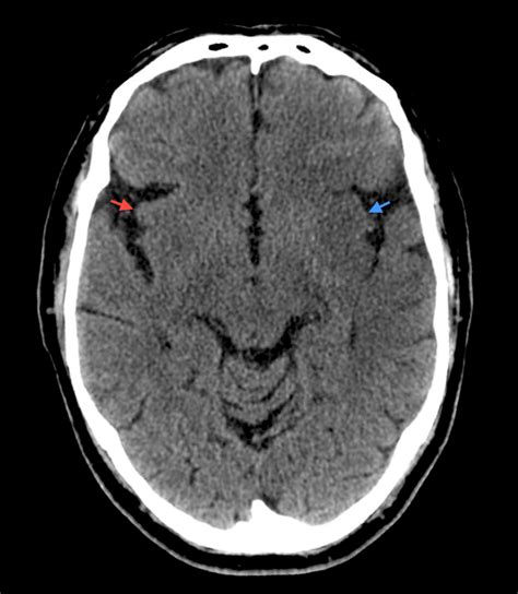 Insular ribbon sign - refers to loss of the normal insular cortex grey-white differentiation and ...