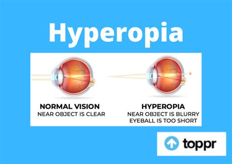 Hyperopia: Introduction, Causes, Types and Symptoms