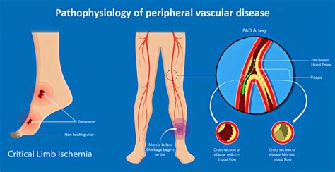 Peripheral Vascular Disease (PVD) | Causes, Symptoms, Diagnosis & Treatment - Page 3 of 13 ...
