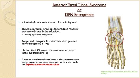 Anterior Tarsal Tunnel Syndrome