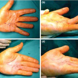 (PDF) Percutaneous needle aponeurotomy for the treatment of Dupuytren's contracture