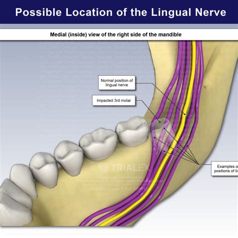 Medical Legal Exhibits - Legal Animations & Trial Graphics - Tria...