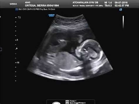 Baby girl's ultrasound at 19 weeks - YouTube