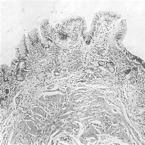 Gastric biopsy specimen of the antrum showing severe atrophy. Only a... | Download Scientific ...