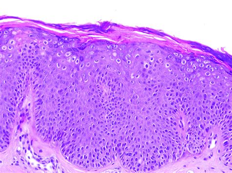 Filiform Wart Histology