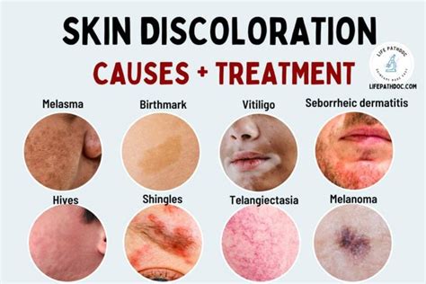 Skin Discoloration: Causes, Pictures, and Treatment