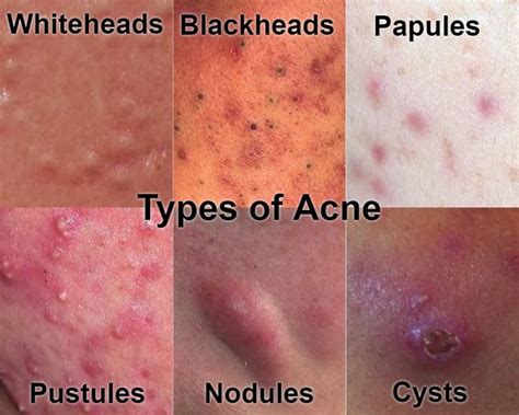 Here is Everything You Need to Know about Curing Acne and More