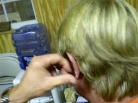 Ear Lobe Infection Part 2 - YouTube