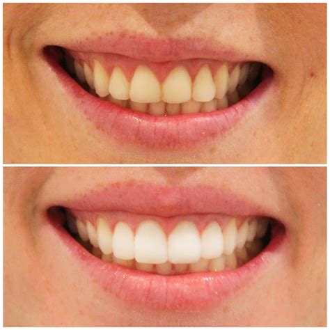 Dental Work Before & After Pictures | Smiling Dental