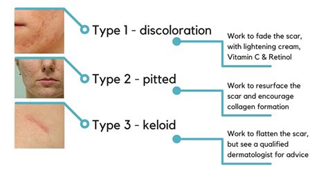 Scar Treatment, Types of Scars