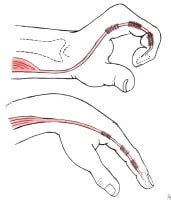 Tendon Transfers: History, Concepts, Timing of Tendon Transfer