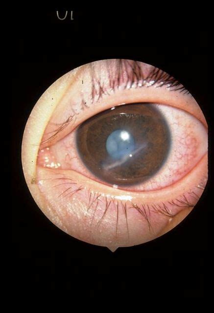 Ocular Laceration - The Clinical Advisor