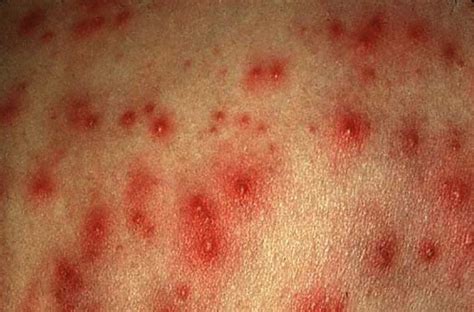 Pseudomonas Folliculitis - Symptoms, Treatment, Pictures, Causes