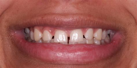 Fill In The Gaps In Your Smile With Bespoke Smile Design