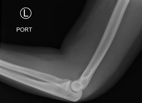 Posterior Elbow Dislocation - JETem