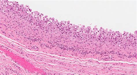 Mucocele Histology