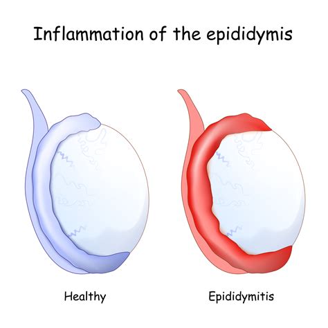 Epididymitis Orchitis | Colin Teo Urology