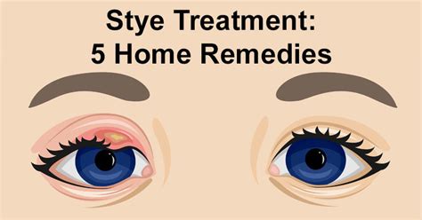 Stye Treatment: 5 Home Remedies - DavidWolfe.com