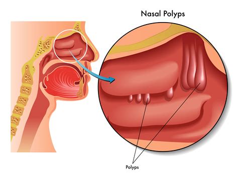 Nasal Polyps | Spain| PDF | PPT| Case Reports | Symptoms | Treatment