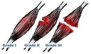 Grade 2: Hip Flexor Muscle Strain - Muscle Pull | Muscle Pull