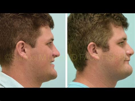 Rhinoplasty Before and After Video Diaries Dallas | Patient Diaries Plano