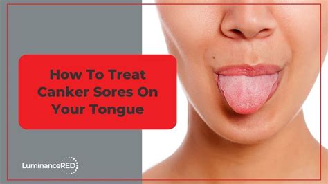 What Causes Canker Sores And How To Get Rid Of Them, 43% OFF