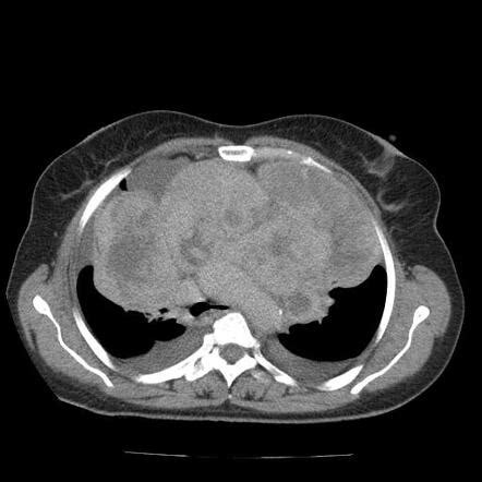 Mediastinal high-grade spindle cell sarcoma | Radiology Case | Radiopaedia.org