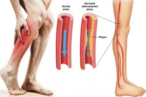 Fibromyalgie et crampes dans les jambes. Ce que vous devez savoir – STAY FIT 247 | Muscle cramp ...