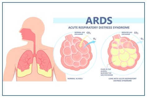 ARDS: Full Form, Symptoms, Complications, and Causes