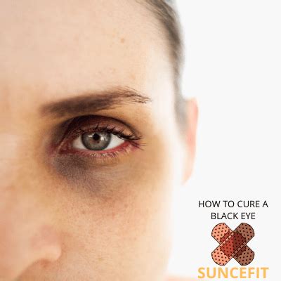 Black Eye Cure: Reduce Swelling and Discoloration Fast