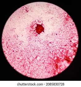 Microscopic View Proliferative Breast Disease Atypia Stock Photo 2085830728 | Shutterstock