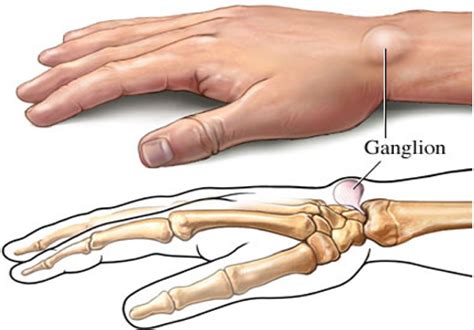 Ganglion Cyst - Causes & Management of Painful Ganglion Cysts